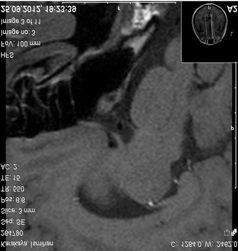 Hipofiz MRI: Adenohipofiz sağ posteriorda