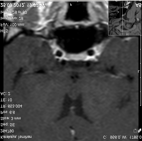 Hipofiz MRI: adenohipofiz sağ posteriorda 3 mm