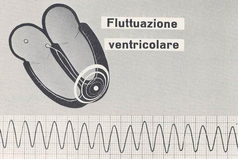 Ventriküler Taşikardi (VT) Ventriküler Taşikardinin (VT) EKG Özellikleri Düzen :