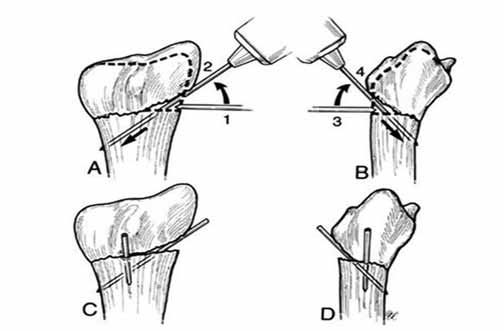 56 Eklem Hastalkları ve Cerrahisi - Joint Diseases and Related Surgery Distal radius kırıkları ortopedi pratiğinde oldukça sık görülmektedir.