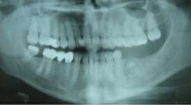 VAKA RAPORU Vaka 1 Sistemik herhangi bir problemi bulunmayan 21 yaşında erkek hasta, Ankara Üniversitesi Diş hekimliği Fakültesine dental tedavilerine yaptırmak üzere başvurmuştur.