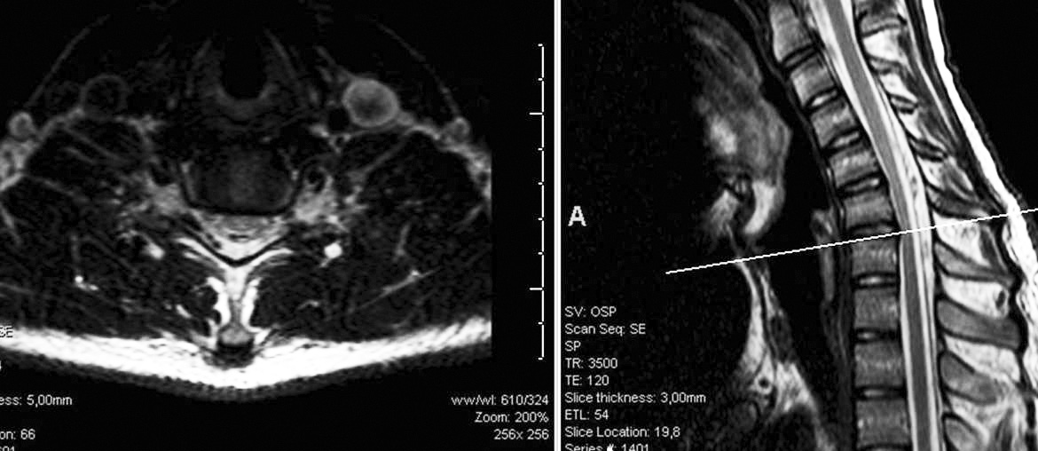 Hirayama Hastalığı ve Tanıda Manyetik Rezonans Görüntülemenin Önemi Resim 2. Nötral-pozisyon aksiyel T2 ağırlıklı MR görüntülemede kord atrofisi izleniyor. A B Resim 3. Fleksiyon MRG çalışmaları.