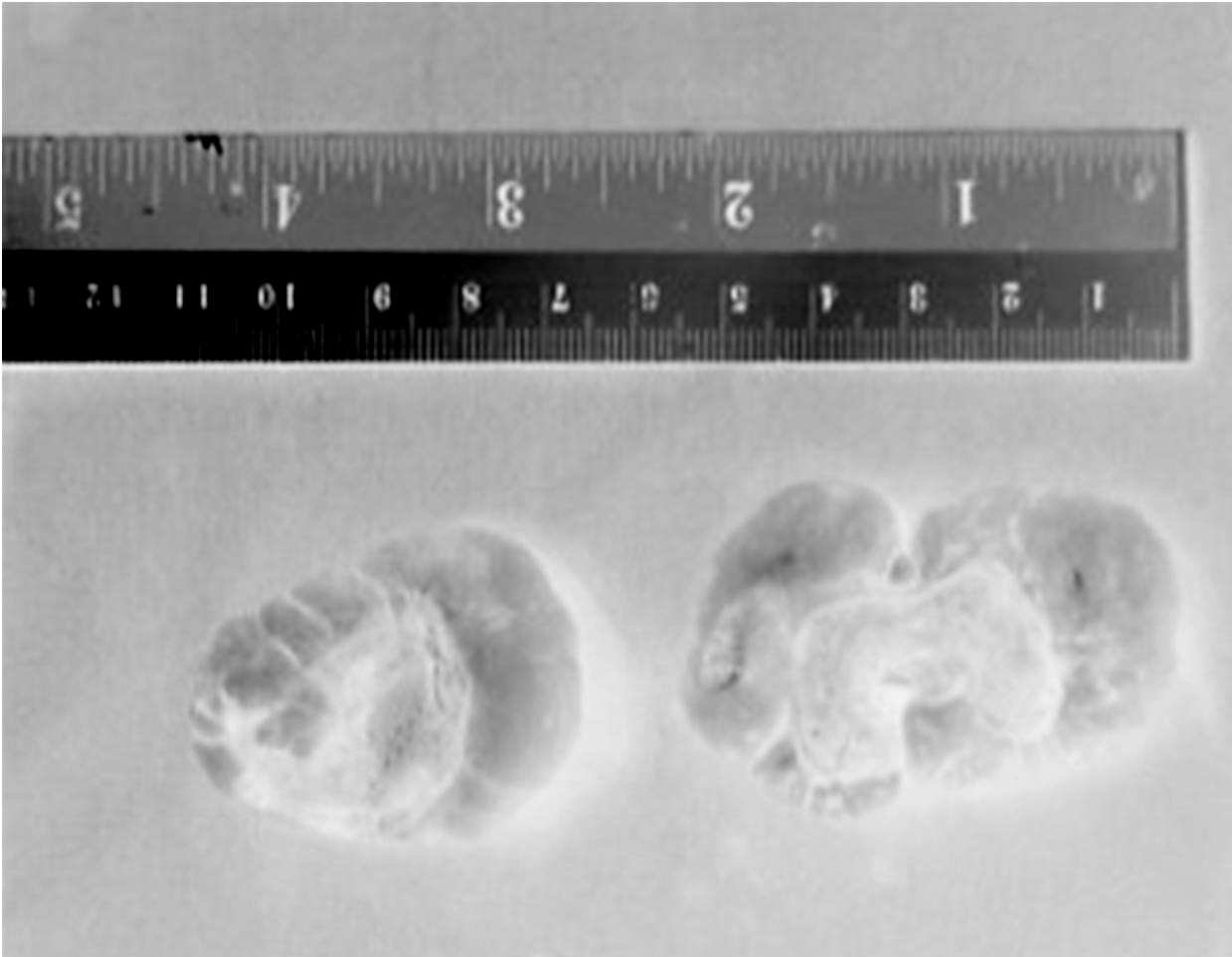 Kulak Lobülünde Küpe Tarzında Bilateral Dev Keloid Olgusu 105 G İ R İ Ş Keloid, yara iyileşmesini takiben gelişen, nedeni çoğu kez ortaya konamayan aşırı fibröz doku artışıdır.