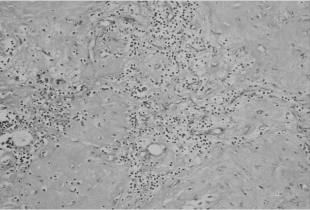 Budak ve ark. Metastazsız burned-out testis tümörü US findings of burned-out tumors may vary; echogenic abnormalities and calcifications can be observed in focal areas (4).