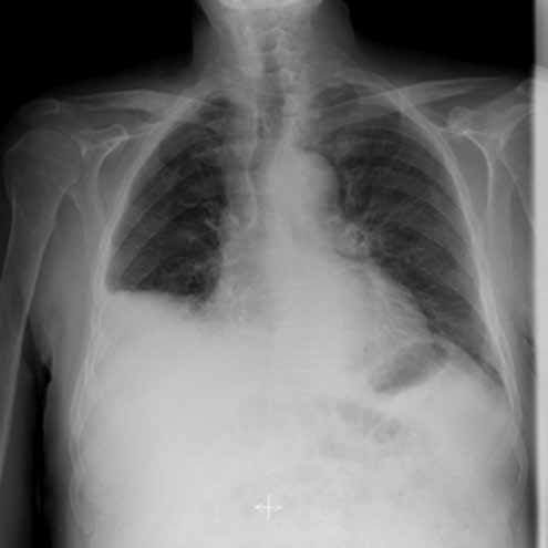 Gözden kaçan bir tanı; transfüzyona bağlı akut akciğer hasarı: Olgu sunumu Tablo 2: Biyokimya takip sonuçları BUN Kre AST ALT LDH İ. bil T.