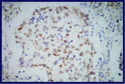 Tablo I Primer akciğer tümörlerinde TTF-1 ekspresyonunun dağılımı Tablo I TTF-1 (-) TTF-1 (+) TOPLAM % (+) Adenokarsinom 7 63 70 %89 SHK 15 3 18 %17 Küçük Hücreli Büyük Hücreli Nöroendokrin Tipik