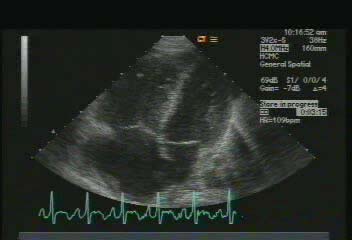 Pulmoner Emboli Normalde RV/LV: 0.