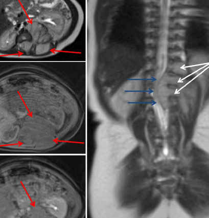 4. Koeller KK, Rosenblum RS, Morrison AL. Fromthe archives of the AFIP: neoplasms of the spinal cord and filum terminale radiologic-pathologic correlation. RadioGraphics 2000; 20:1721 1749. 5.