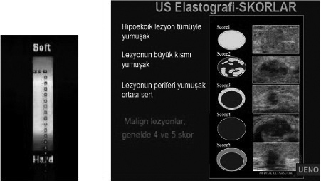 tiroid kanser insidansının 1973 te 100.000 de 6.3, iken 2002 de 8.7 olduğunu bildiren çalışmalar vardır (3).