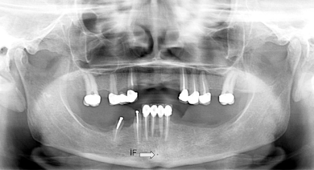 A.Pınar SUMER, A.Zeynep ZENGİN, Soner ÇANKAYA, Uğur MERCAN 27 Resim 1. Panoramik radyografta mandibular kanal [MK], insisiv kanal [İK] ve mental foramenin [MF] görünümü. Resim 2.