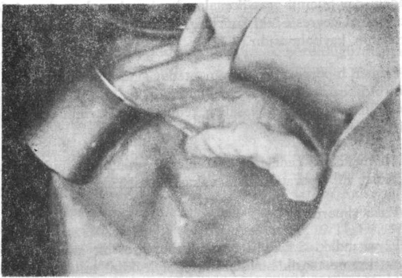 BROVVN TÜMÖR Resim 1 : Sağ maksiller premoler - moler bölgesindeki üzeri normal görünümlü mukoza ile kaplı ekspansif