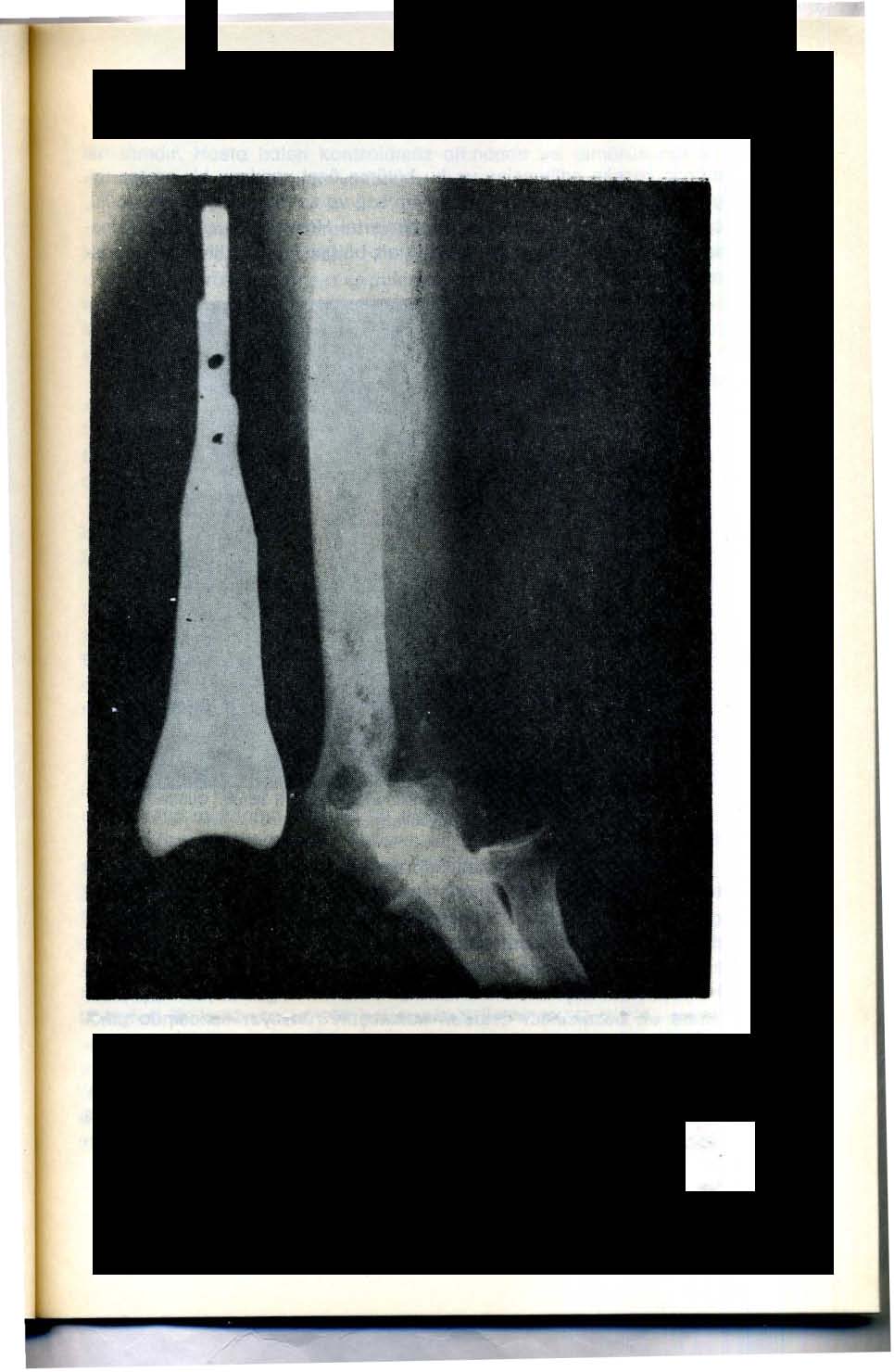 Resim 5 - Sol humerus dış kandili rezeke edilmiş, Cubitis valgus gelişmiş, ayrıca humerus ic kandilinde tümör yeniden oluşmuştur( Humerus yanında, uygulanacak özel protezin görünümü (Radyolojik