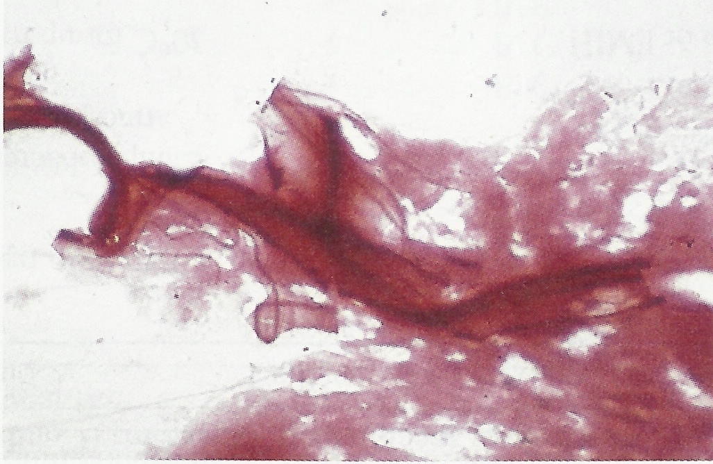 11 PMNL + mikst bakteri