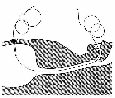 Şekil 6: İğne ile ponksiyon sonrası ip yerine kanülden esnek bir tel geçirilir.