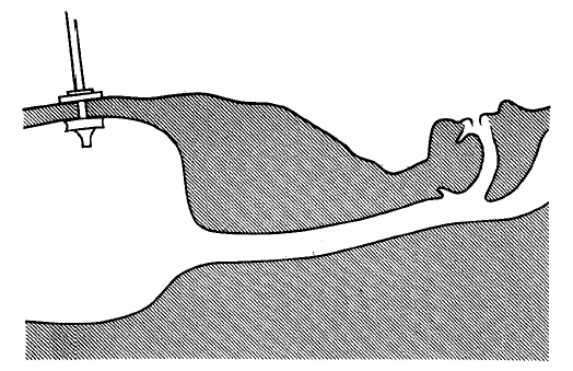 Şekil 8: Kılavuz tel üzerine yerleştirilen gastrostomi tüpü, endoskop yardımıyla itilerek özefagus, mide ve abdominal duvar yönünce itilir.