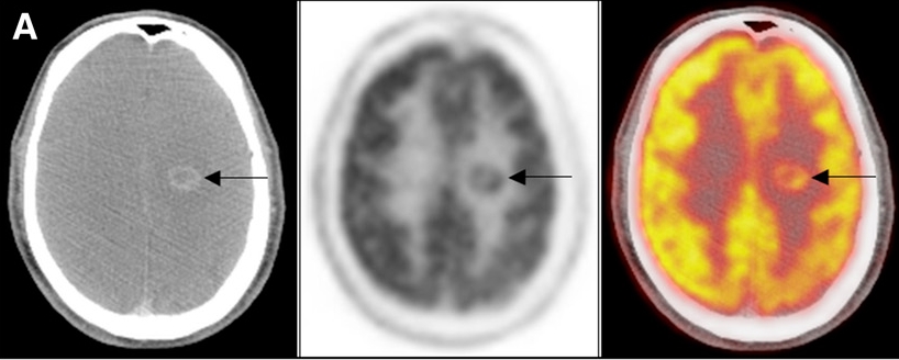 PET-BT ile beyin met tanısı 18F-FDG PET ile MR da (+) Met tanı oranı %
