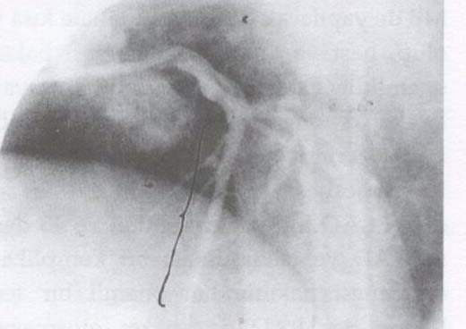 T. Paker ve ark. Sol Ön İnen Koroner Arterde Myocardial Bridging-Cerrahi Tedavi ve Sonuçlar Sonuçlar Peroperatuar dönemde hiçbir hastada enzim ve EKG değişikliği olmadı, inotropik destek gerekmedi.