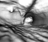 Resim 1. Mesane arka duvar yerleflimli polipoid tümörün aksiyel T (A) ve sanal sistoskopik () görünümü. nu ile 10 mm kesit kal nl ğ ve 10 mm/sn masa kayma h z ile gerçekleştirildi.