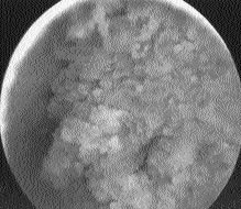 C Resim 2. Sol posterolateral duvar yerleflimli düzensiz yüzeyli tümöral lezyonun aksiyel (A), sanal sistoskopi () ve konvansiyonel sistoskopi (C) görünümü.
