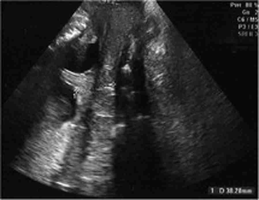 Ultrasonografik servikal uzunluk ölçümü ve fetal fibronektin testinin gerçek preterm eylemi tespit etmedeki yeri dahil edildi.