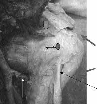 Bölükbafl ve ark. Tekrarlayan anterior omuz instabilitesinin aç k cerrahi tedavisi 53 lir. Matsen, subskapularis ve kapsülün birbirinden ayr lmadan mediale ekarte edilmesini önermifltir.