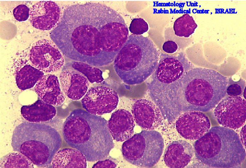 Şekil III. 1. :multiple myeloma, [plazma hücreleri tarafından anormal sayıda, tek tip antikor üretimi sonucu oluşan bir hastalık].