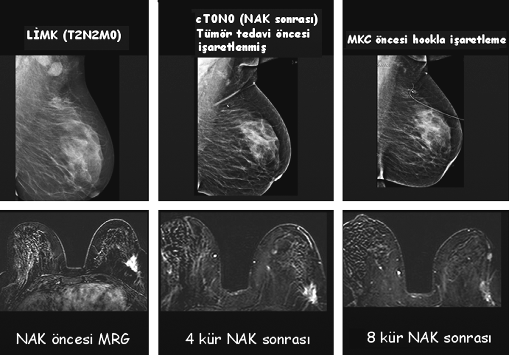 Şekil 2. Neoadjuvan kemoterapiden önce ve sonra mamografi ve MRG (allta). NAK sonrası tümör cevabının artması, bu hastalarda MKC oranının %50 nin üzerine çıkmasını sağlamıştır (9).