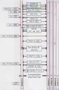 59 ~75 kda 27 kda 32 kda arası çiftli band oluşumu ~11-12 kda arası band oluşumu i j k l m Şekil 3.3. DFS70 Pozitif Serumların Hep-2 Westernblot Çalışma Sonuçları. i. Değerlendirme stripi, j,k ve l DFS 70 pozitif hastalara ait stripler, m DFS 70 negatif hastaya ait strip.