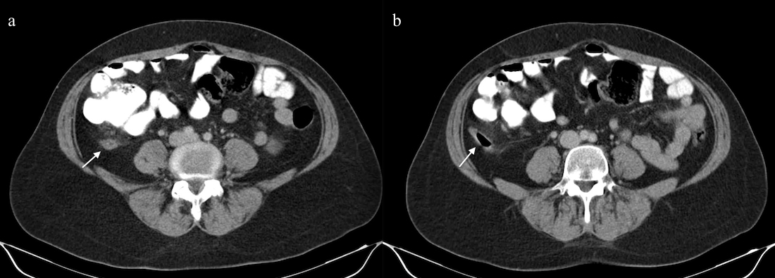 32 Şekil 5.2. Standart abdomen BT incelemesi yapılan 41 yaşındaki bir kadın hastaya ait, iki farklı düzeyden alınan aksiyel görüntüler.