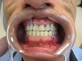 Resim. 1. Alt ve üst çenede bulunan dişler Resim 4. Üst çenede bulunan dişlerin preparasyonu Resim 2. Alt ve üst çenede bulunan protezlerin ağız içi görünümü Resim 5.