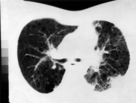 Şen S, Kutlay H, Çakmak H, Dikmen E, Kavukçu Ş, Ekinci C. Resim 1. Olgunun preoperatif posteroanterior akciğer grafisi. Resim 2. Olgunun akciğer biyopsisinin histopatolojik görünümü.
