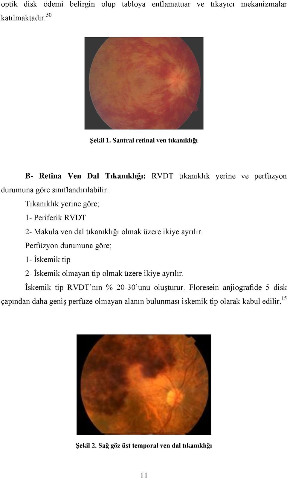Periferik RVDT 2- Makula ven dal tıkanıklığı olmak üzere ikiye ayrılır. Perfüzyon durumuna göre; 1- Ġskemik tip 2- Ġskemik olmayan tip olmak üzere ikiye ayrılır.