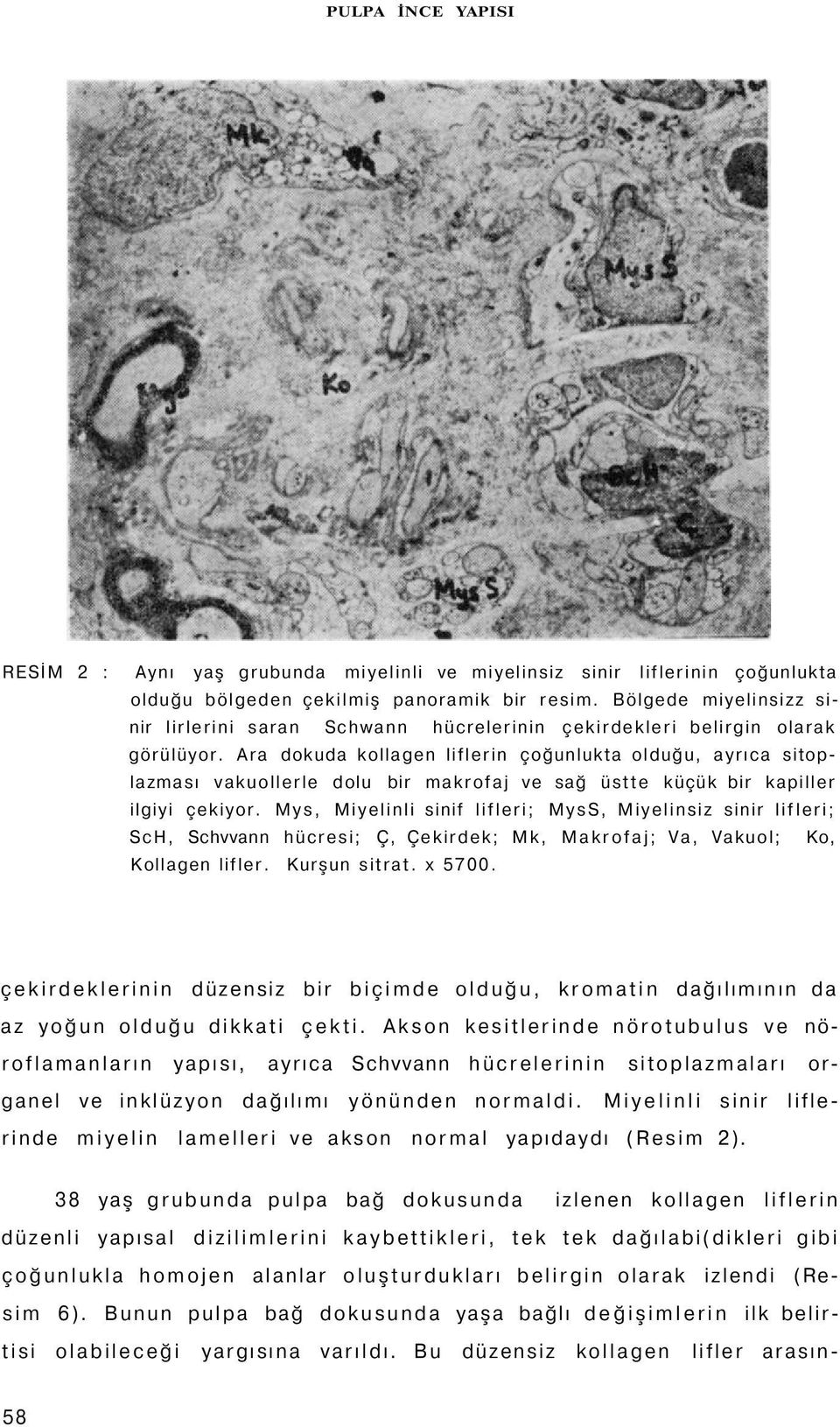 Ara dokuda kollagen liflerin çoğunlukta olduğu, ayrıca sitoplazması vakuollerle dolu bir makrofaj ve sağ üstte küçük bir kapiller ilgiyi çekiyor.