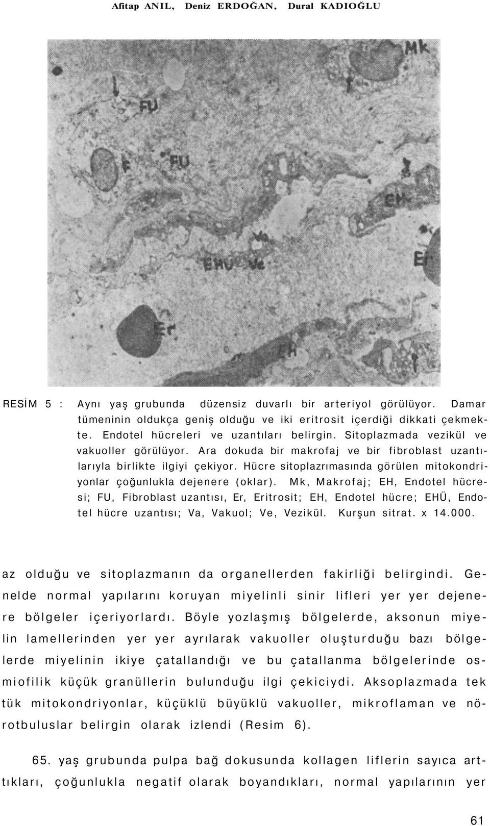 Hücre sitoplazrımasında görülen mitokondriyonlar çoğunlukla dejenere (oklar).