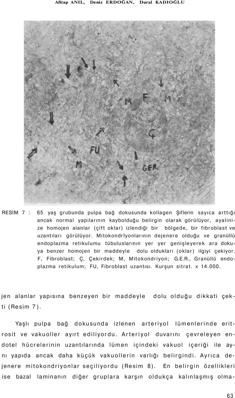 Mitokondrîyonlarının dejenere olduğu ve granüllü endoplazma retikulumu tübuluslarının yer yer genişleyerek ara dokuya benzer homojen bir maddeyle dolu oldukları (oklar) ilgiyi çekiyor.