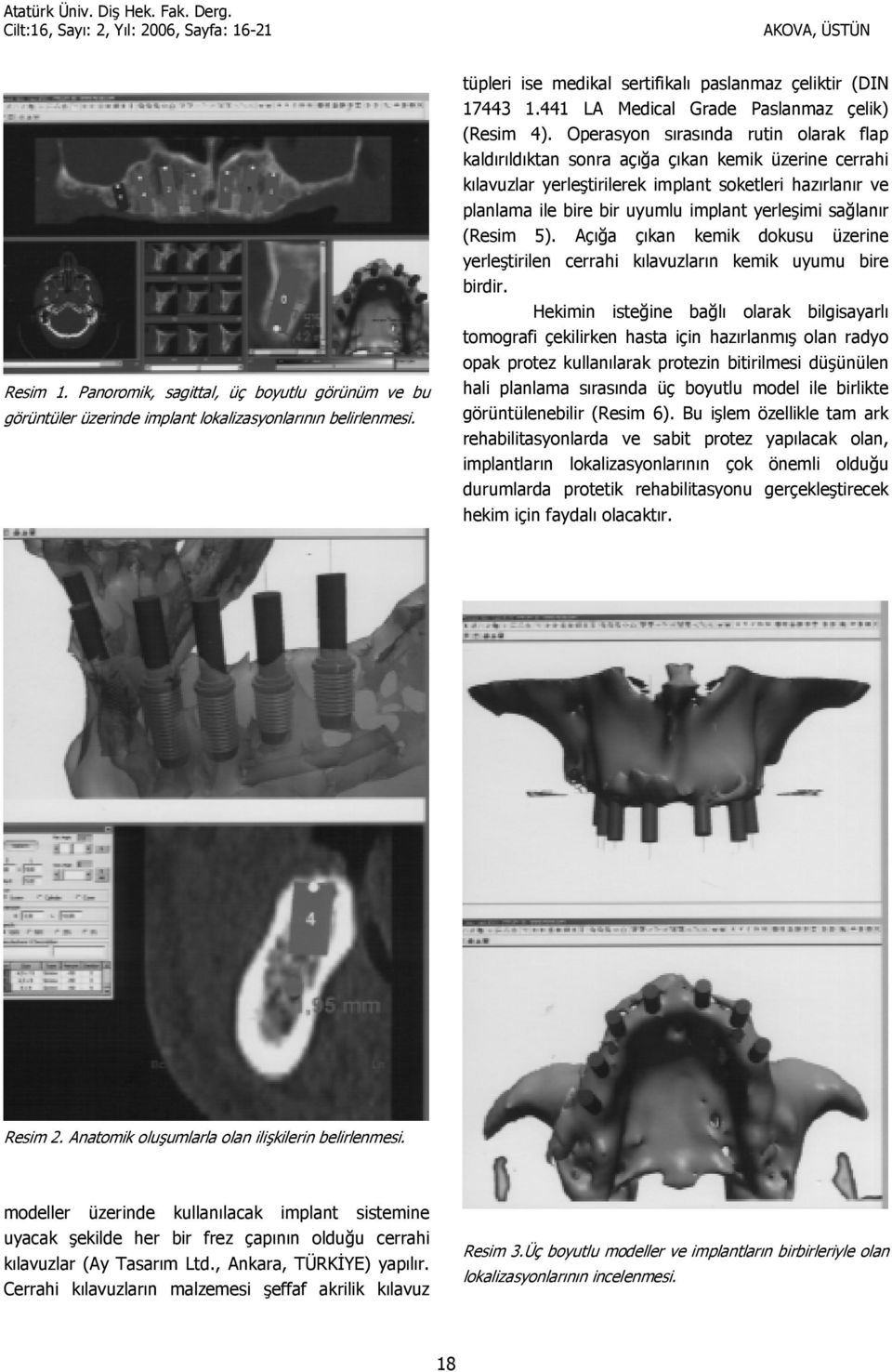 Operasyon srasnda rutin olarak flap kaldrldktan sonra aç3a çkan kemik üzerine cerrahi klavuzlar yerletirilerek implant soketleri hazrlanr ve planlama ile bire bir uyumlu implant yerleimi sa3lanr