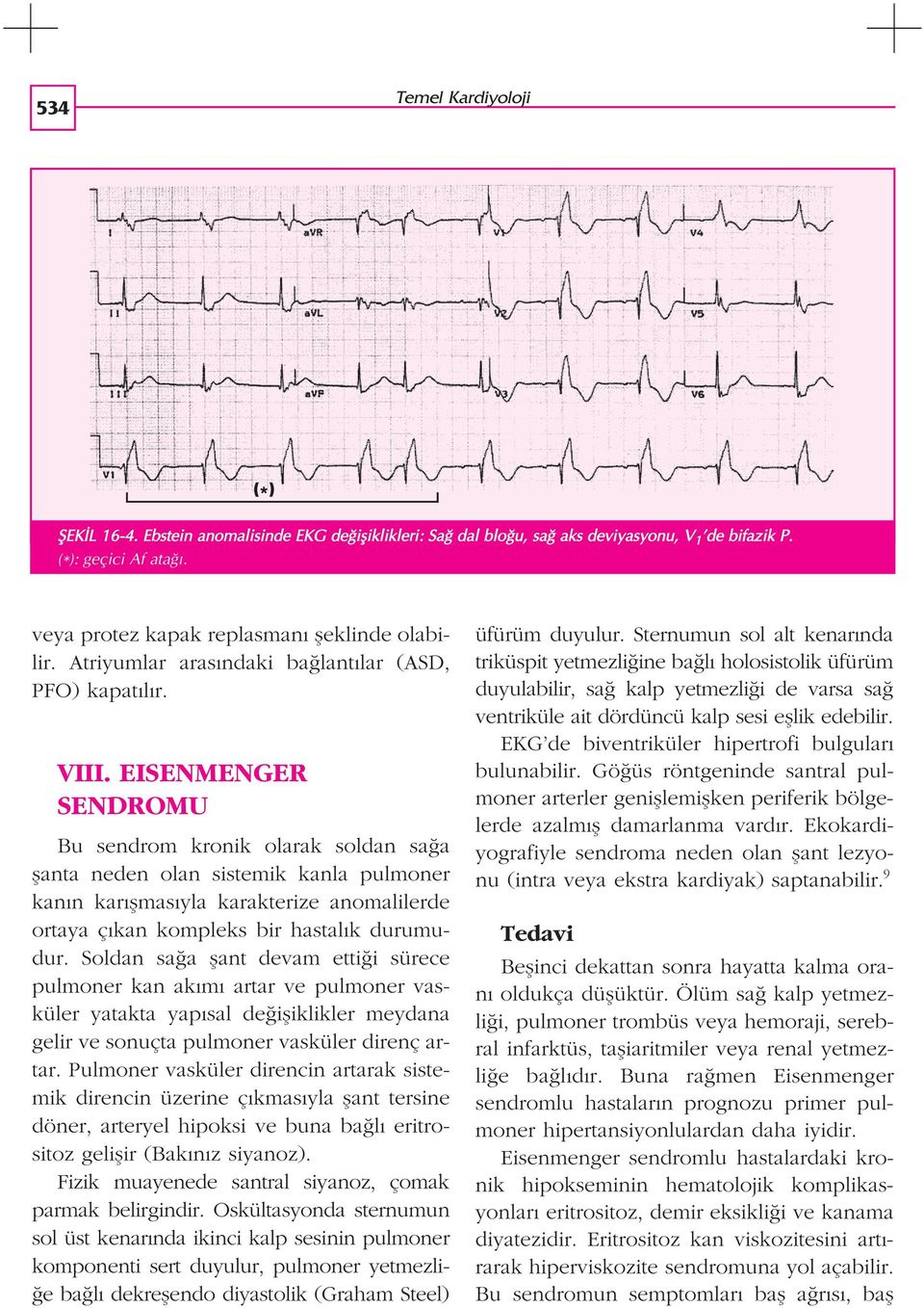 EISENMENGER SENDROMU Bu sendrom kronik olarak soldan sa a flanta neden olan sistemik kanla pulmoner kan n kar flmas yla karakterize anomalilerde ortaya ç kan kompleks bir hastal k durumudur.