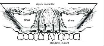 Resim 2. Standart implantlarla desteklenen zigoma implantları 8 yaklaşımda zigomatik implant başı alveol kretine yakın bir şekilde pozisyonlandırılır.