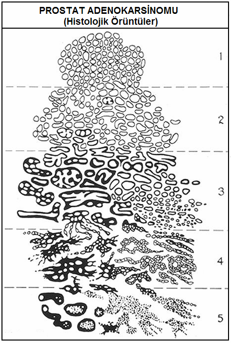 Şekil 2.4. Gleason derecelendirme sistemine göre hücre farklılaşması. 2.2.2. Prostat Kanserinde Etiyoloji Prostat kanseri gelişimi için risk faktörleri, tam olarak anlaşılamamıştır.