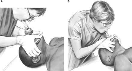 Mouth-to-Mouth Rescue Breathing