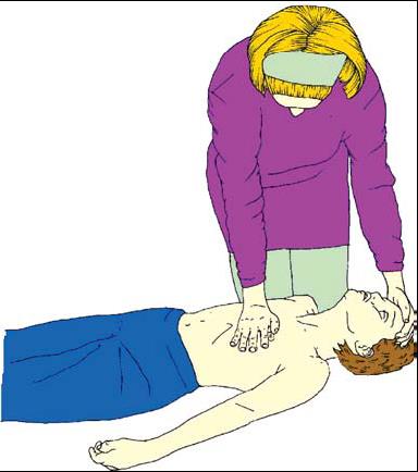 AGE C : V RATIO /RATE POSITION RESCUE BREATHS AED Infant < 1 year of age 15:2 / 100 min Tips of 2 fingers on the lower third of the sternum Mouth-to mouth and nose ventilation NO Child