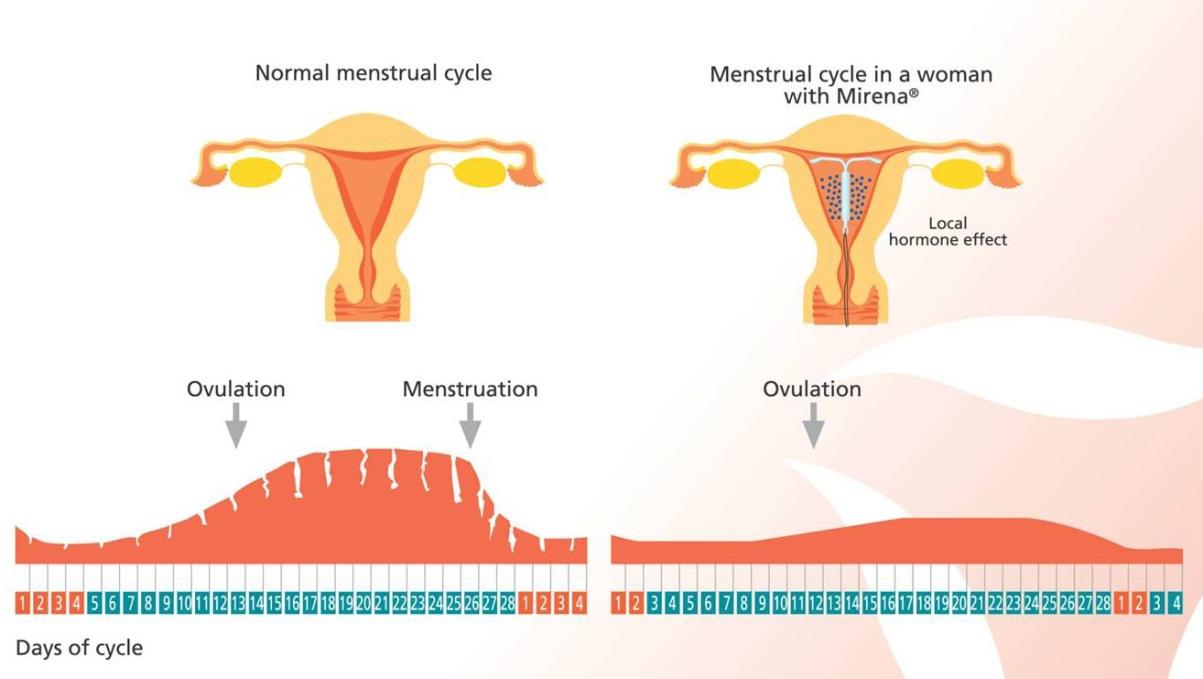 Menorajilerde LNG-IUS LNG-IUS endometrial etkileri Kanama miktarını 12 ayda %97 azaltır