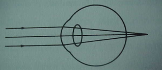 Hipermetropi Görüntü retinanın arkasına düşer, akomodasyon ile uzak net görülebilir Latent