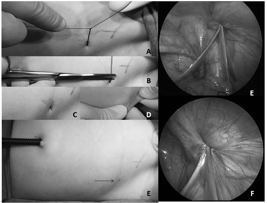 Ç. A. Karadağ, İnguinal herni cerrahisinde PIRS yöntemi: Teknik ayrıntılar iki ucu dışarıda bulunan birinci ip ve iç yarısında ise ucu bu halka ip tarafından tutulan ikinci ip durmaktadır.