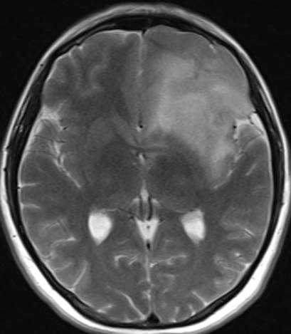 Bilateral Broca s ve Wernicke Solda tümörün