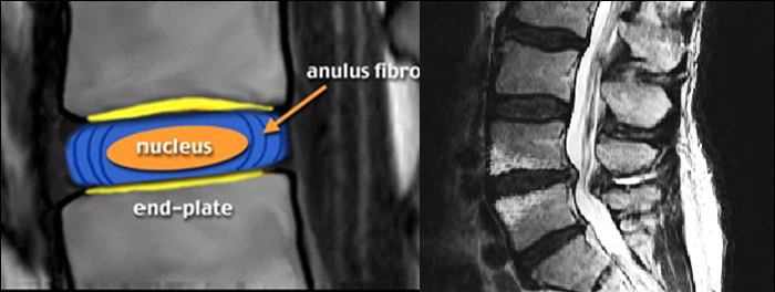 SCHMORL NODÜLÜ İntravertebral herniasyon (Schmorl Nodülü) Hard disk hernisi/kronik disk hernisi; kalsifiye disk hernisi Pseudodisk taşması: Spondilolistezis