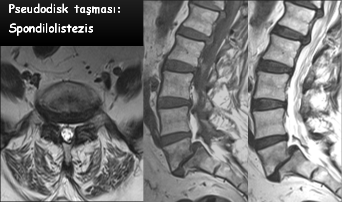 6-12 aylık MR takibi Disk hernilerinin %63 ünde volüm azalması Radiology 1992; 185: pp. 35-141 Spine 1996; 21: pp.