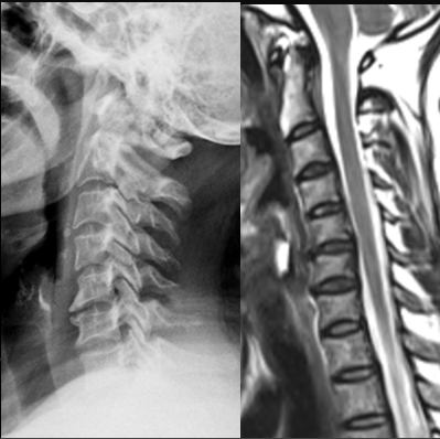 Tip2 değişikliği Tip 1 e dönüyorsa dejenerasyon artıyor veya osteomyelit gelişiyor Semptom olması şart değil Spondilosis Deformans: Yaşlanma süreci