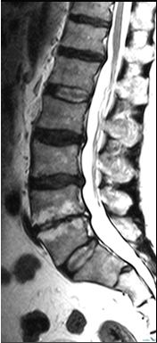 Spondilosis Deformans: Spondilosis Deformans: Servikal Bölge; Unkovertebral eklemde osteofit Spondilosis deformans İV osteokondrosis: Patolojik süreç Nükleus pulpozus