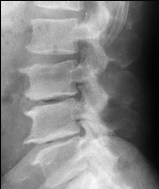 İV osteokondrosis: Patolojik süreç En sık L4-5 ve L5-S1 İV disk Fibrozis Siyah-T2 Yüseklik kaybı Dejeneratif disk hastalığı İV osteokondrosis: İV disk yükseklik Kaybı İV